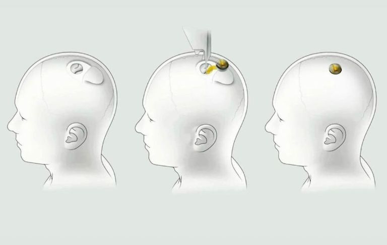 Cuándo inician las pruebas de Neuralink